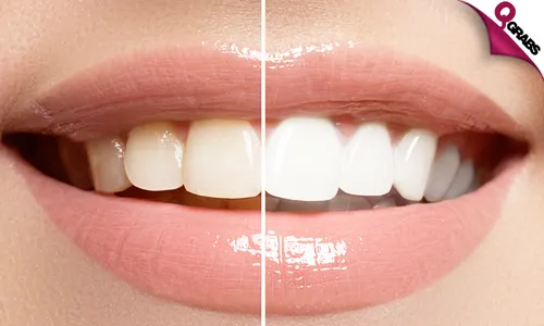 Zoom Whitening Home Kit + Consultation!